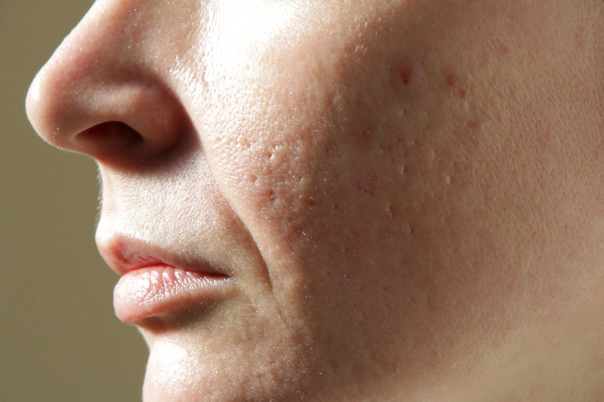 Open Pores